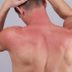 Need Sunburn Remedies? Here's What Dermatologists Do