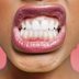 7 Surprising Home Remedies for Teeth Grinding