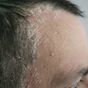 psoriasis on the hairline and on the scalp-close up, dermatological diseases, skin problems