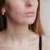 What Is Post-Inflammatory Erythema? These Post-Acne Red Spots Aren't Scars