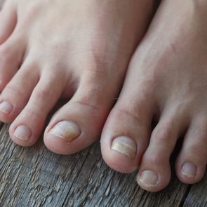 Close-up of legs with fungus on nails on wooden background.