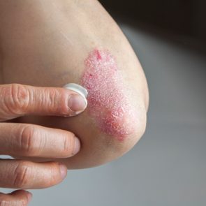 Psoriasis on elbow