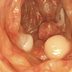 8 Symptoms of Colon Polyps