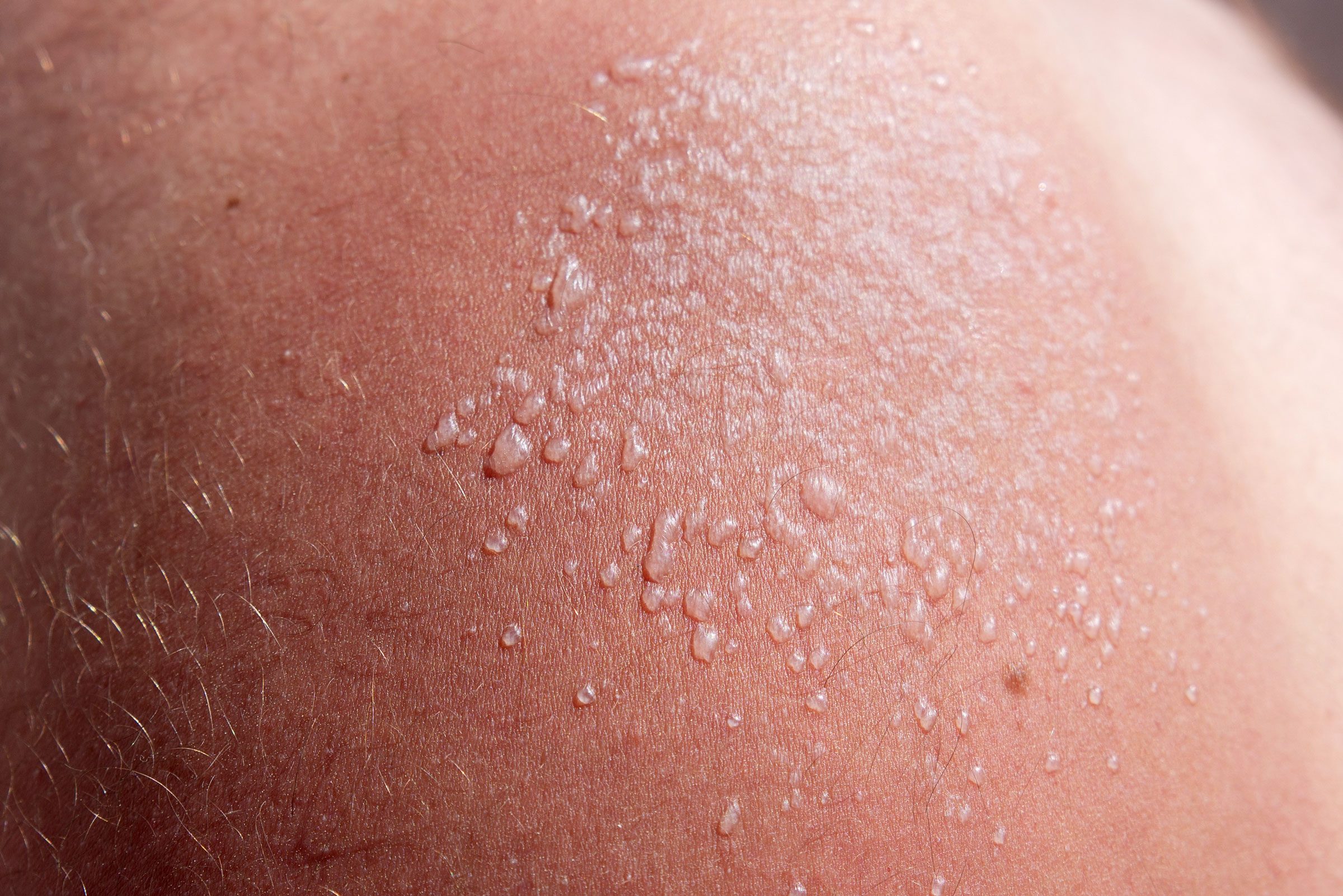 Sun Blister: Here’s How to Tell If You Have One, and How to Treat It